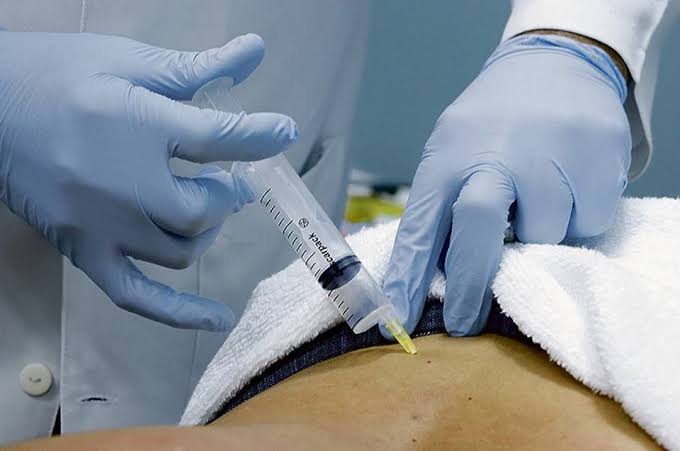 Ozonioterapia